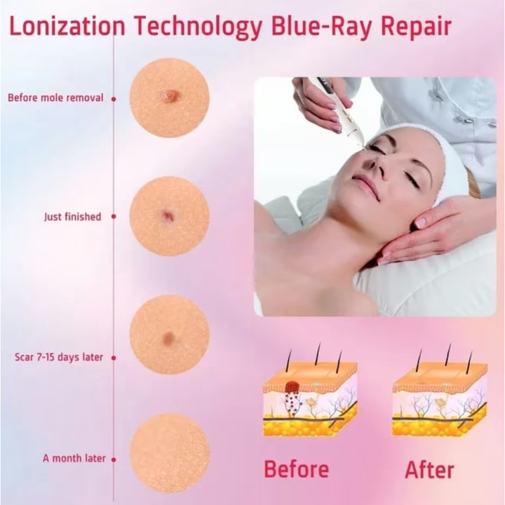 AOVO Plazma toll eszköz, LCD kijelző, 9 intenzitási fokozat, fehér